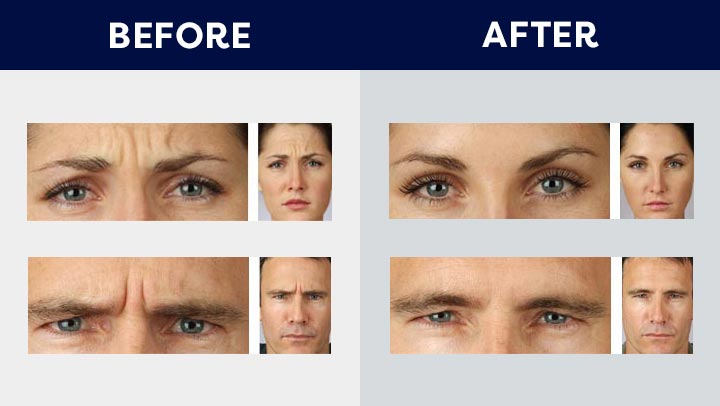 Cosmetic Uses Of Botox South Bay Ophthalmology 3598