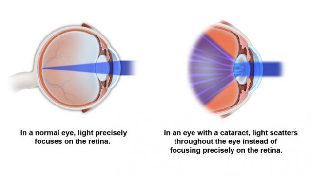 Cataract | South Bay Ophthalmology