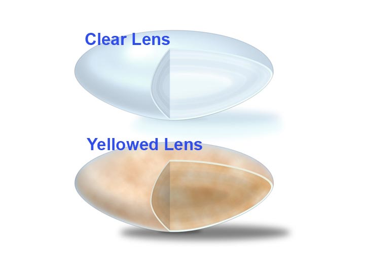 Cataract South Bay Ophthalmology