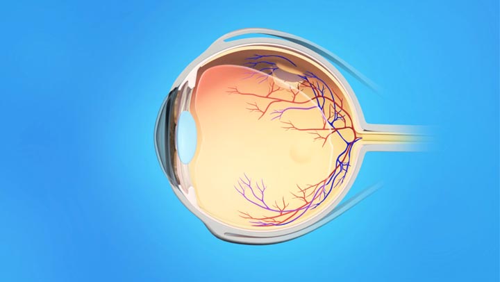 Pe Topic Retinal Tears Detachments South Bay Ophthalmology